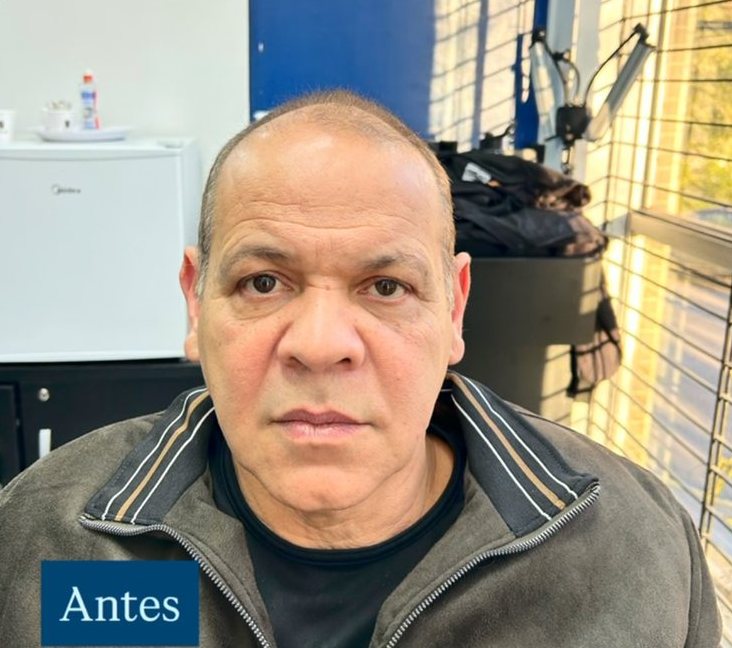 Cliente antes da prótese capilar