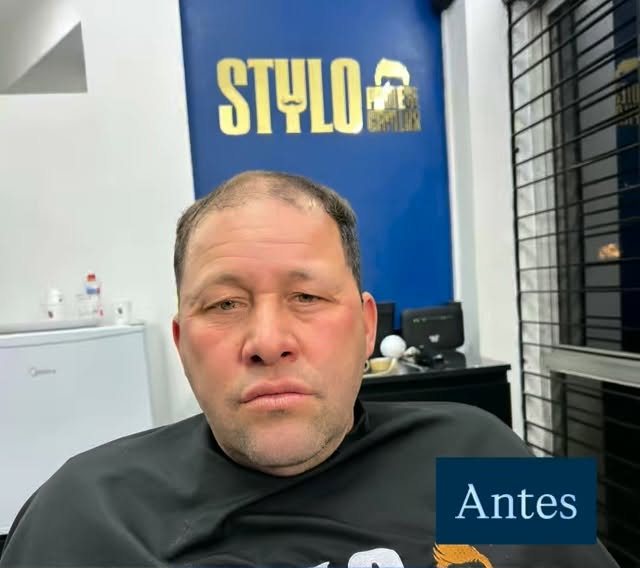 Cliente antes da prótese capilar