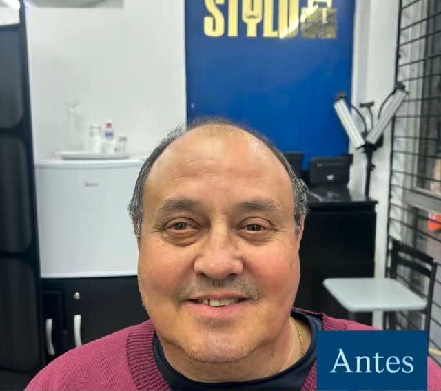 Cliente antes da prótese capilar